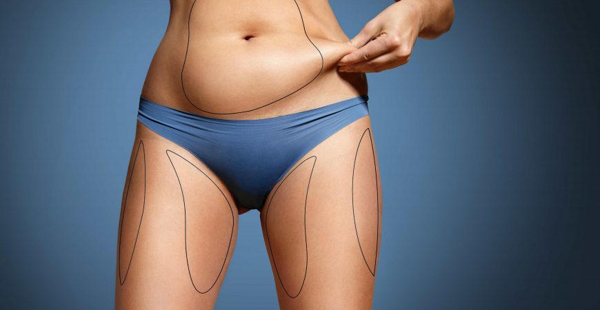 Liposuction